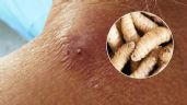 Foto ilustrativa de la nota titulada Alerta en México: Confirman primer caso de miasis por gusano barrenador en humanos