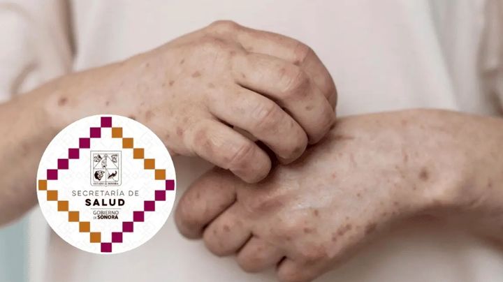 Supervisa SEC que no se desarrollen brotes de sarampión en escuelas de Sonora