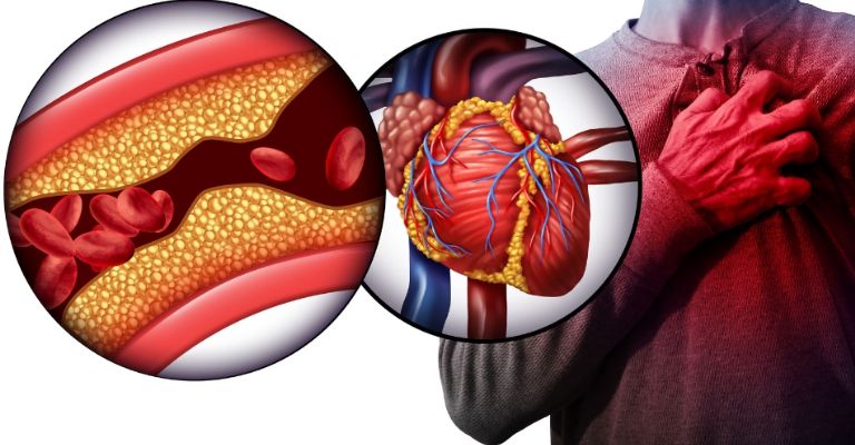 Las arterias obstruidas pueden causar ataques al corazón