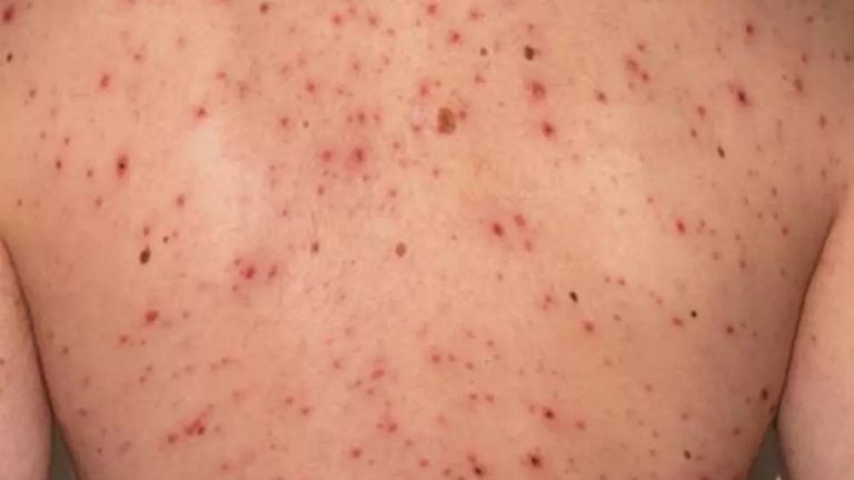 La única prevención para el sarampión es la vacuna: Salud Municipal de Cajeme