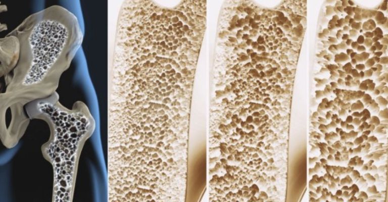 Así es cómo se van debilitando los huesos con la osteoporosis
