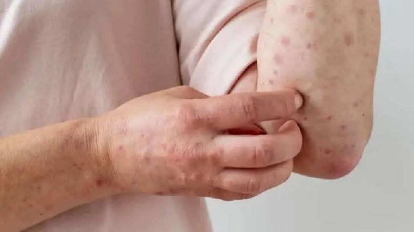 La única prevención para el sarampión es la vacuna: Salud Municipal de Cajeme