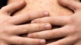 Foto que representa a Empalme concentra el 80% de casos de sarampión en Sonora; autoridades toman acciones