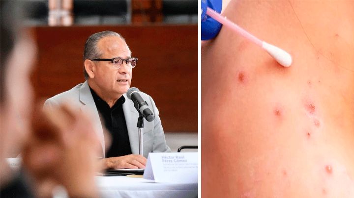 México: Primer muerto por viruela del mono en Jalisco, informó Secretaría de Salud