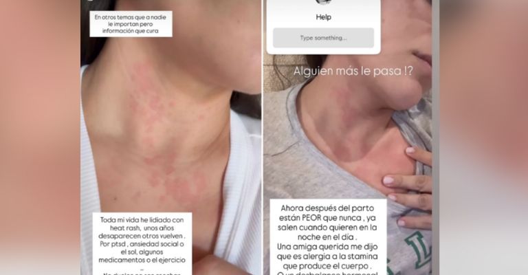 Ana Brenda Contreras exhibe el terrible padecimiento que la aqueja y progresa rápido