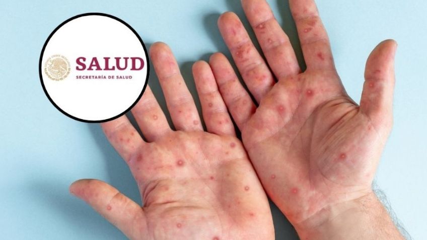 ALERTA NACIONAL: México enfrenta brote de sarampión, las autoridades piden a la población vacunarse