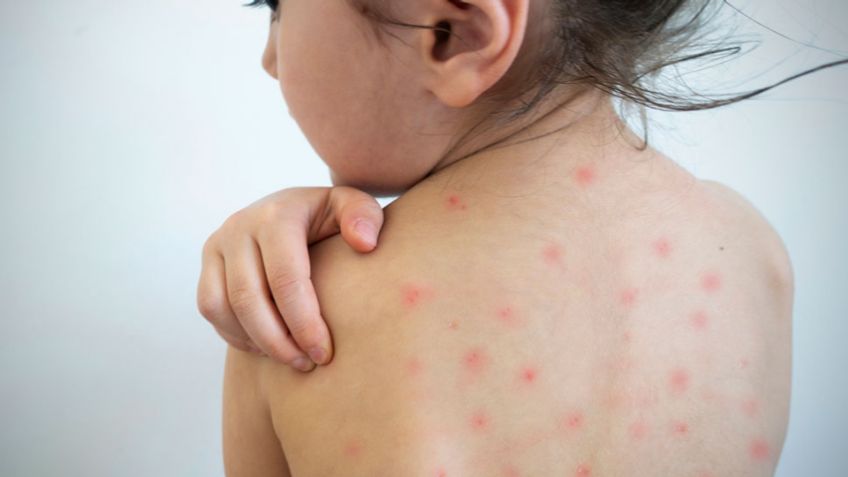 Bebé de seis meses se convierte en el tercer caso confirmado de sarampión en Tlaxcala