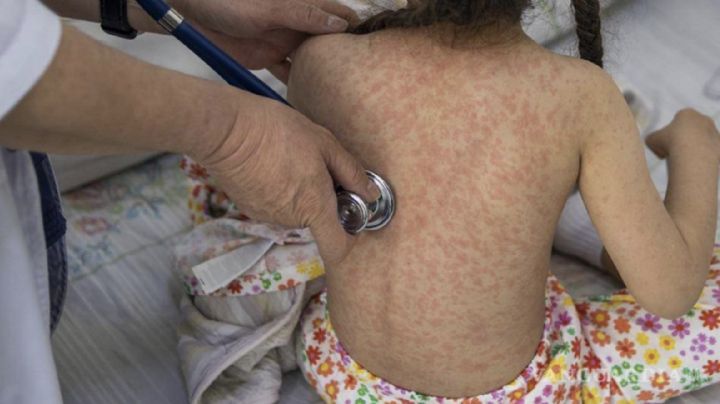 Sarampión en México: 7 estados concentran el 85% de los casos; ¿es obligatorio usar CUBREBOCAS?