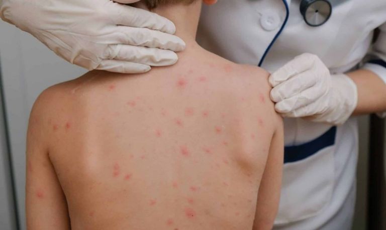 Salud Sonora refuerza prevención del sarampión y realiza búsqueda activa de cualquier caso sospechoso  