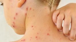 Foto que representa a ¿Cuántas mueres por sarampión registra Sonora? Gobierno de Sheinbaum confirma más 30 casos activos