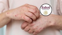 Foto que representa a Secretaría de Salud confirma 31 muertes por sarampión en México; hay más de 9 mil contagios registrados