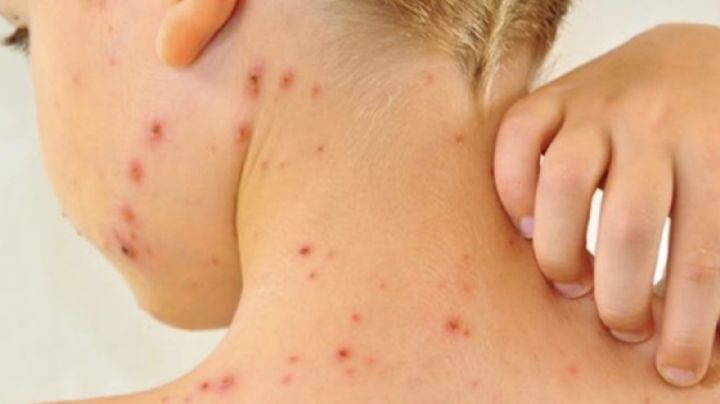 ¿Cuántas mueres por sarampión registra Sonora? Gobierno de Sheinbaum confirma más 30 casos activos