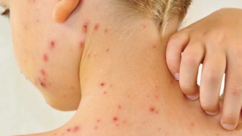 ¿Cuántas mueres por sarampión registra Sonora? Gobierno de Sheinbaum confirma más 30 casos activos