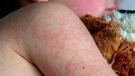 Foto que representa a ¿Qué hacer para evitar el sarampión? Medidas de prevención ante el repunte de contagios en México