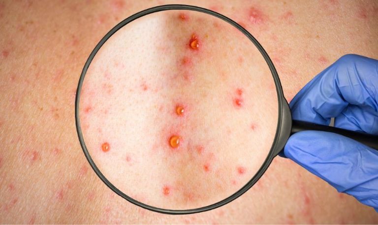 El uso de cubrebocas contra sarampión es innecesario si cuentas con esquema completo de vacunación