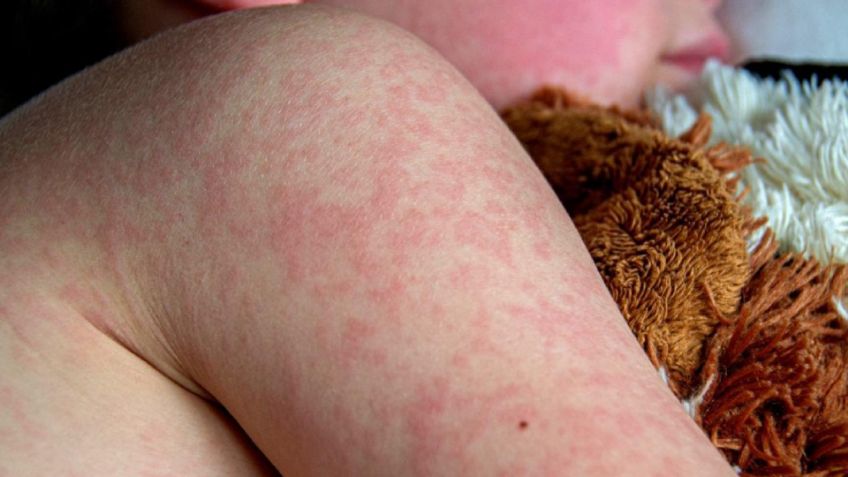 ¿Qué hacer para evitar el sarampión? Medidas de prevención ante el repunte de contagios en México