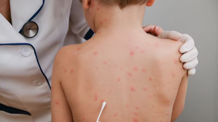 "Casos de sarampión están bajo control en el sur de Sonora": Salud Municipal de Navojoa