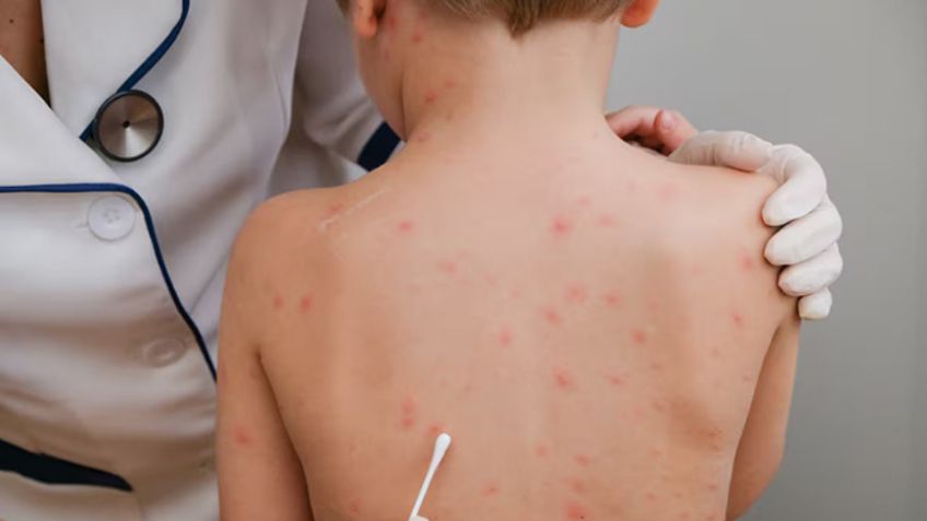 "Casos de sarampión están bajo control en el sur de Sonora": Salud Municipal de Navojoa