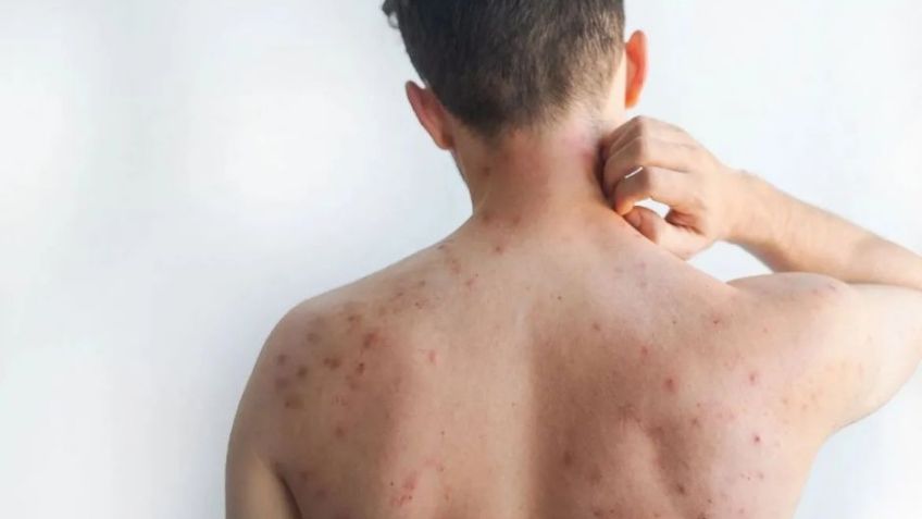 El aumento de casos de sarampión en México deja 32 muertes; la mayoría de las víctimas son niños