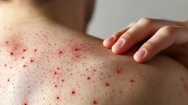 Foto que representa a OPS emite ALERTA epidemiológica por AUMENTO de casos de sarampión en América en 2026