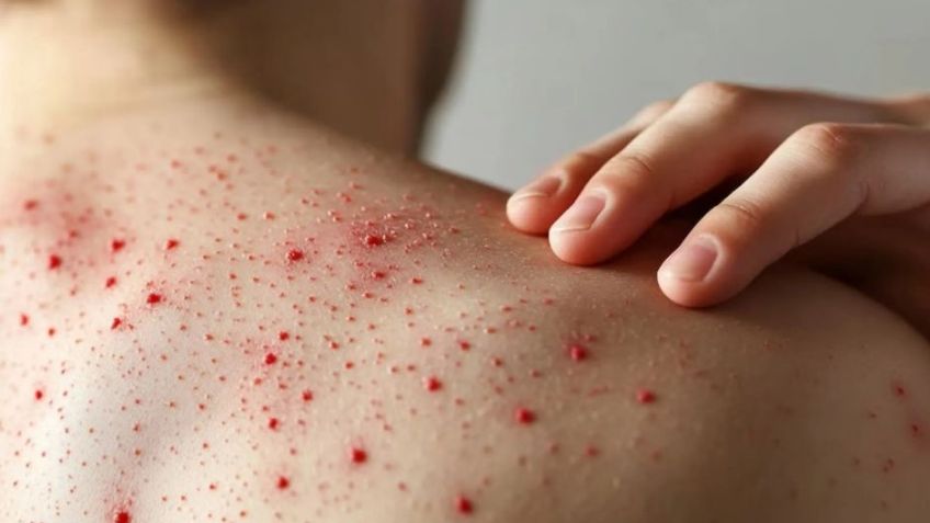 OPS emite ALERTA epidemiológica por AUMENTO de casos de sarampión en América en 2026