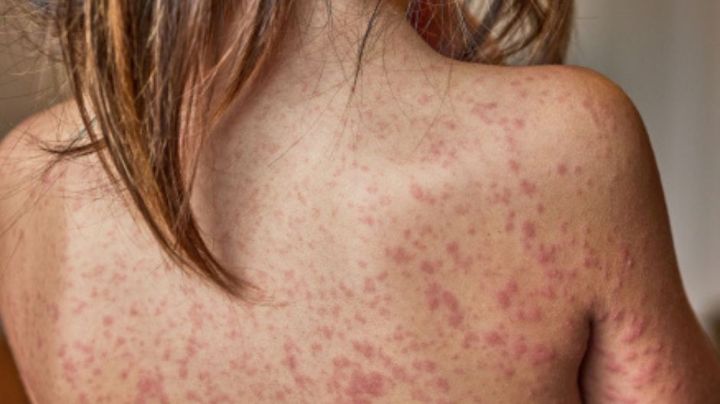 Sarampión supera los 10 mil casos en México; el brote ha causado 31 fallecimientos en el país