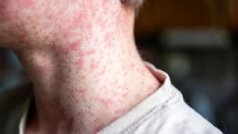 Foto que representa a ¿Es seguro vacunarse otra vez contra el sarampión? Médicos explican qué pasa si recibes una dosis adicional
