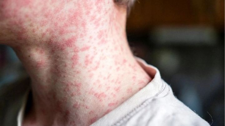 ¿Es seguro vacunarse otra vez contra el sarampión? Médicos explican qué pasa si recibes una dosis adicional