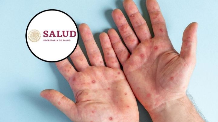 Se registran más de dos mil casos confirmados de sarampión en México en lo que va de 2026