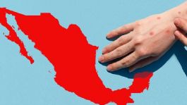 Foto que representa a México es el país más afectado por el sarampión en América; se registran más de 14 mil casos