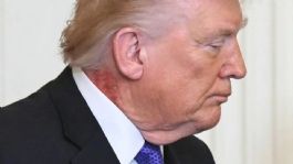 Foto que representa a Trump muestra sarpullido visible en el cuello durante acto oficial en la Casa Blanca; genera preocupación
