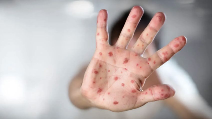 Sonora, entre los 11 estados con más casos de sarampión en 2026: Llaman a la VACUNACIÓN