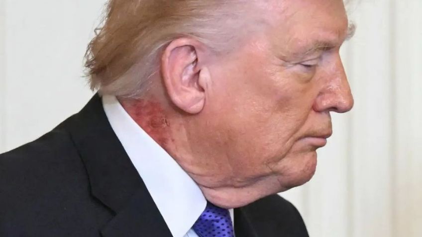 Trump muestra sarpullido visible en el cuello durante acto oficial en la Casa Blanca; genera preocupación